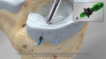 JuggerStitch. Meniscal repair device