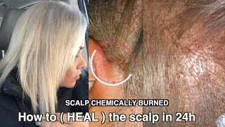 Severe Scalp Chemically Burned | How to heal the scalp after bleached your hair ( it work )