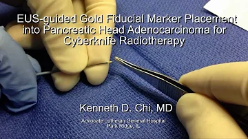 What are markers for pancreatic cancer?