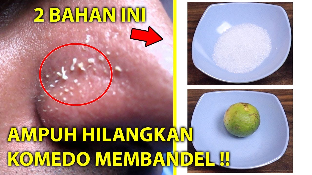 Cara Menghilangkan Komedo Putih dan Hitam 