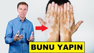 Vitiligo İçin Bu Üç Şeyi Yapmalısınız | Dr.Berg Türkçe Resimi