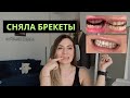 ПОЧЕМУ ПЕРЕПЛАТИЛА В 2 РАЗА. Брекеты до и после в 37 лет