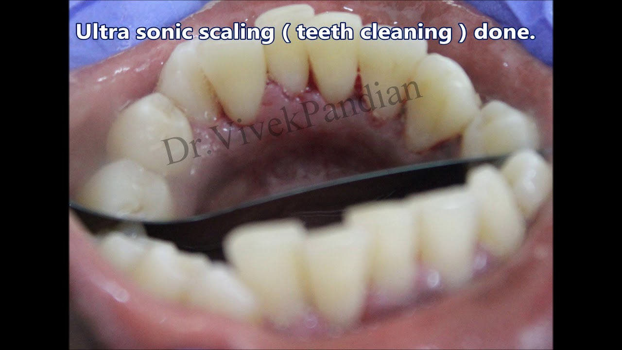 Dental Cleaning Treatment in Chennai YouTube