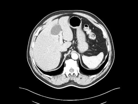 Video: Ce este esofagul distal?