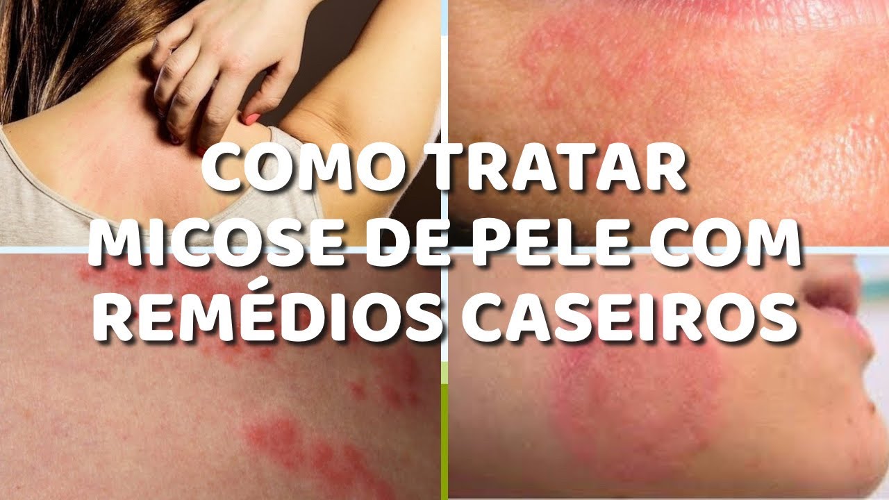 ACABE COM A MICOSE DE PELE RAPIDAMENTE - YouTube