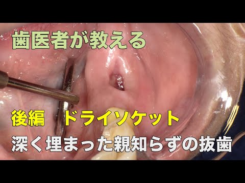 [Naito dentistry] 2020 produced horizontal impaction type wisdom tooth extraction (second part)