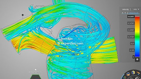 CFD simulation of the blood flow in an artery with aneurysm - ANSYS Discovery LIVE 2021 R1