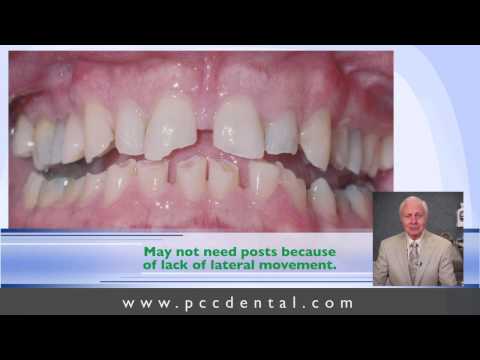 Ask Gordon: How does occlusion influence post & core