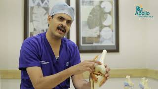 Knee Cap Dislocation Treatment | Dr. Pradeep Kocheeppan, Orthopedician | Apollo Hospitals Jayanagar