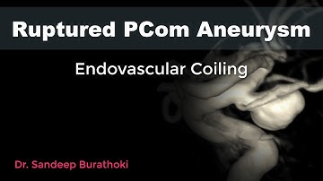 Ruptured Left PCom Aneurysm Coiling