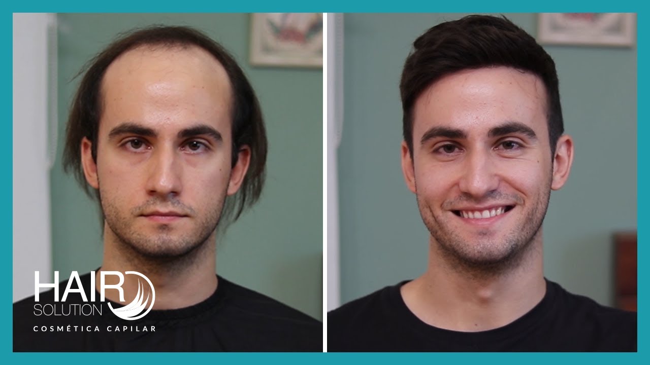 Prótesis capilares Antes y después Hair replacement system YouTube