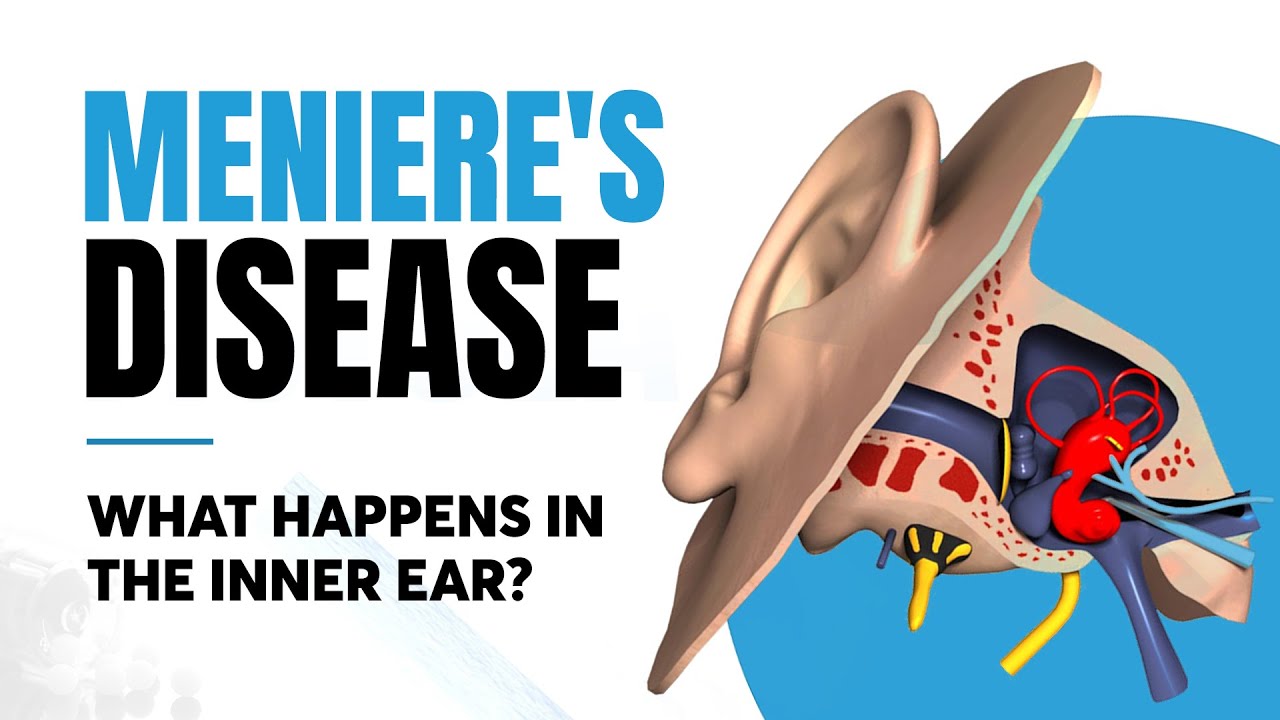Meniere's Disease Inner Ear Impacts! YouTube