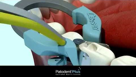 Henry Schein UK -- Palodent Plus Sectional Matrix System -- 60 Second Overview