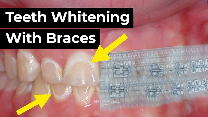 Teeth Whitening with Braces?!
