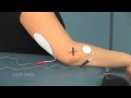 Electrode placement for supination option 1