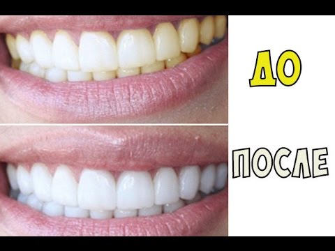 Отбеливание зубов стоматология хабаровск