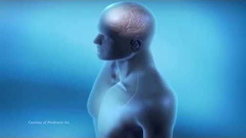 Deep Brain Stimulation (DBS): Stages of Surgery