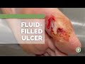 FLUID 💦 FILLED ULCER