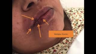Herpes Labialis