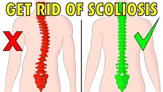 How to fix scoliosis naturally in 4 minutes a day Resimi