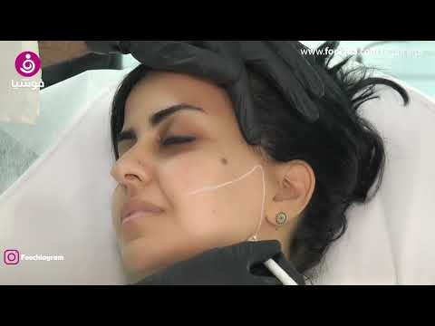 فيديو: التجديد السريع: أسلم أنواع عمليات شد الوجه