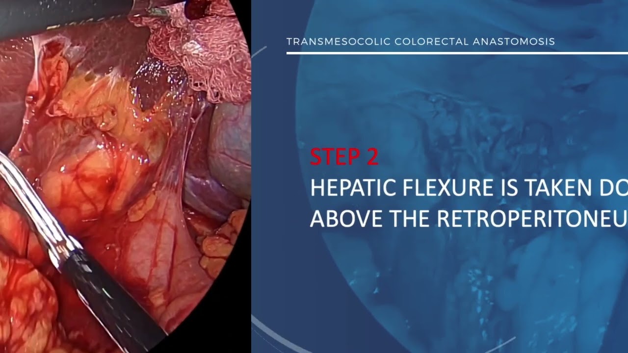 Tension-Free Colorectal Anastomosis via the Duodenal Window: A Technical Note