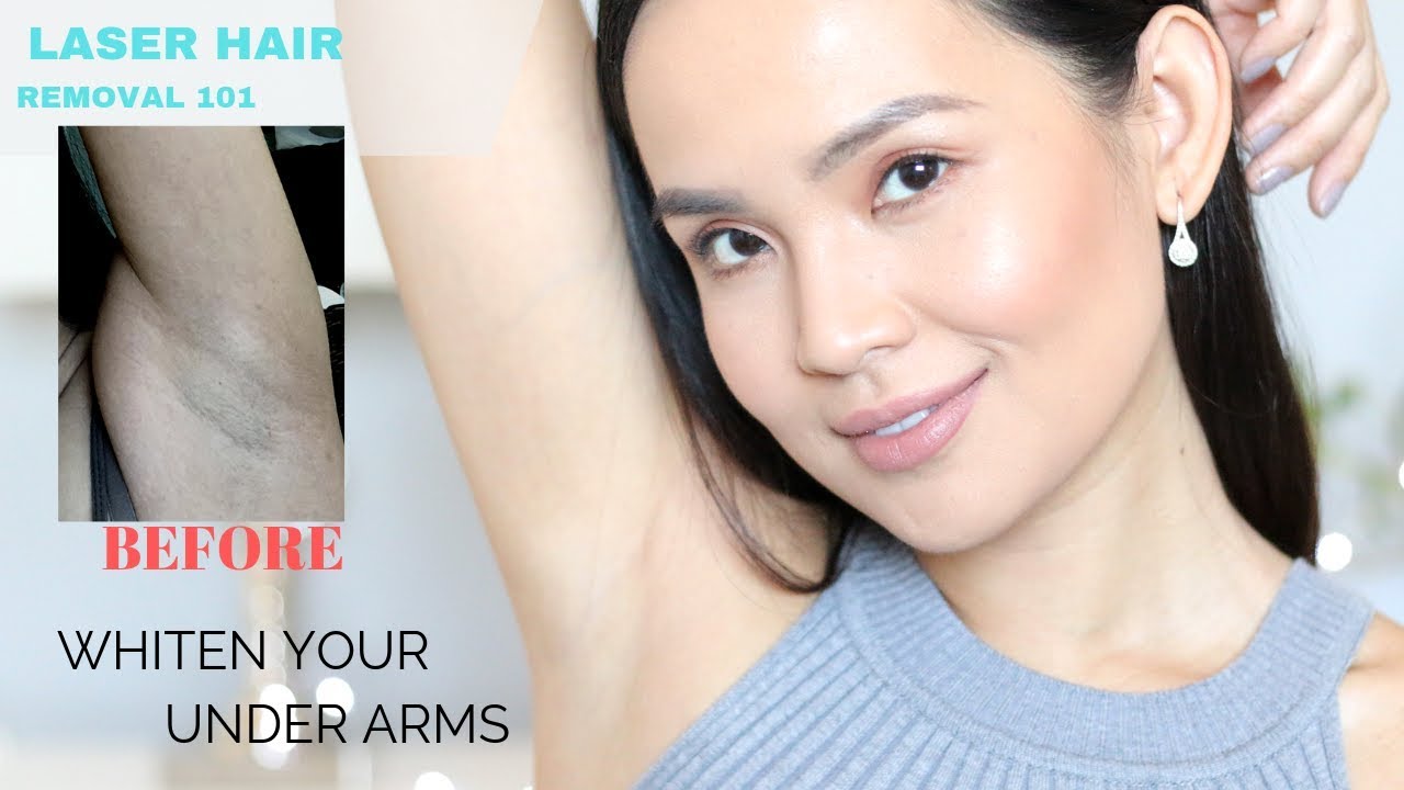 The TRUTH About Laser Hair Removal! My Experience + How to lighten underarms  - YouTube