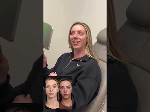 Video thumbnail: “It's a big change” 😍 | Dr. Schrader Reveals Stunning Rhinoplasty Results · Becker Aesthetics & Plastic Surgery