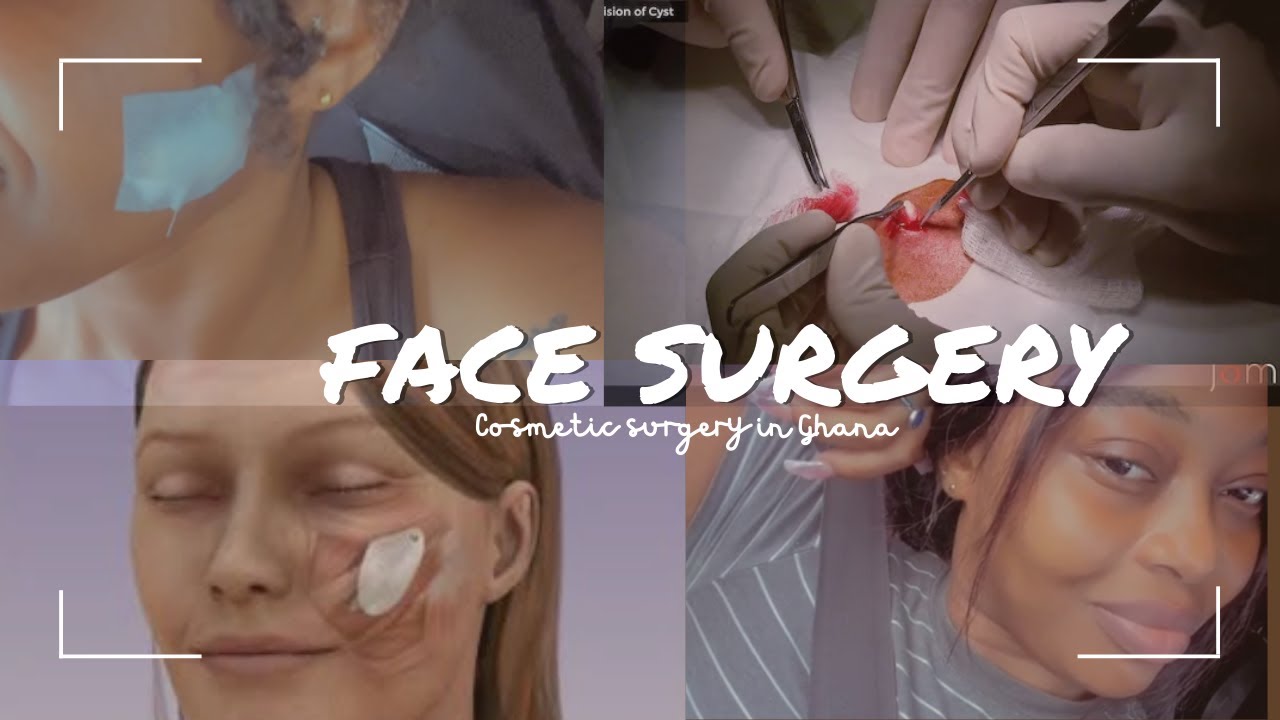 COSMETIC FACE SURGERY IN GHANA SEBACEOUS CYST REMOVAL YouTube