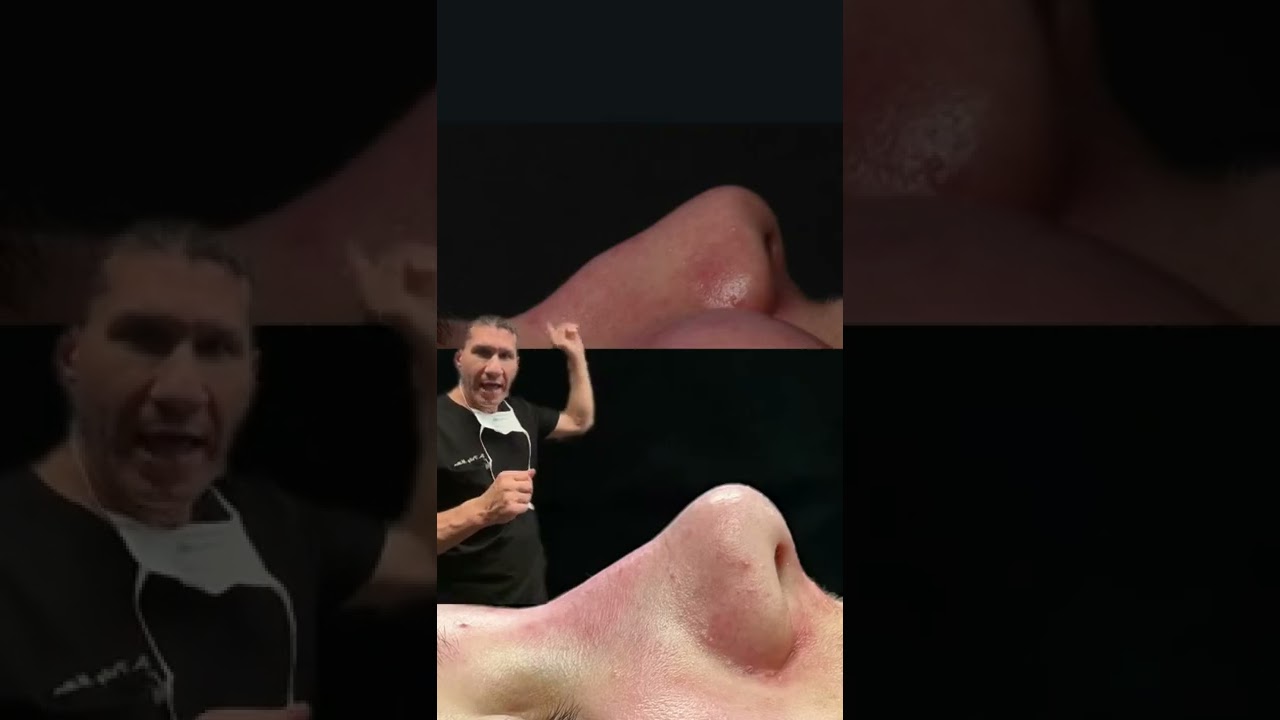 Micro Rhinoplasty, Done Under Local Anesthesia, What Can It Achieve?