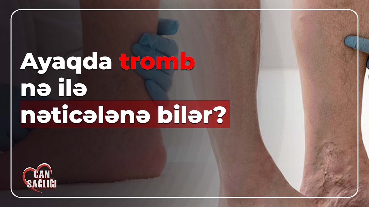 Ayaqda tromb nədən yaranır? - Can Sağlığı (30.04.2024)