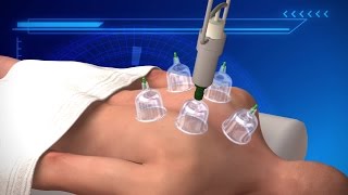Cupping therapy: Why Michael Phelps has big red bruises