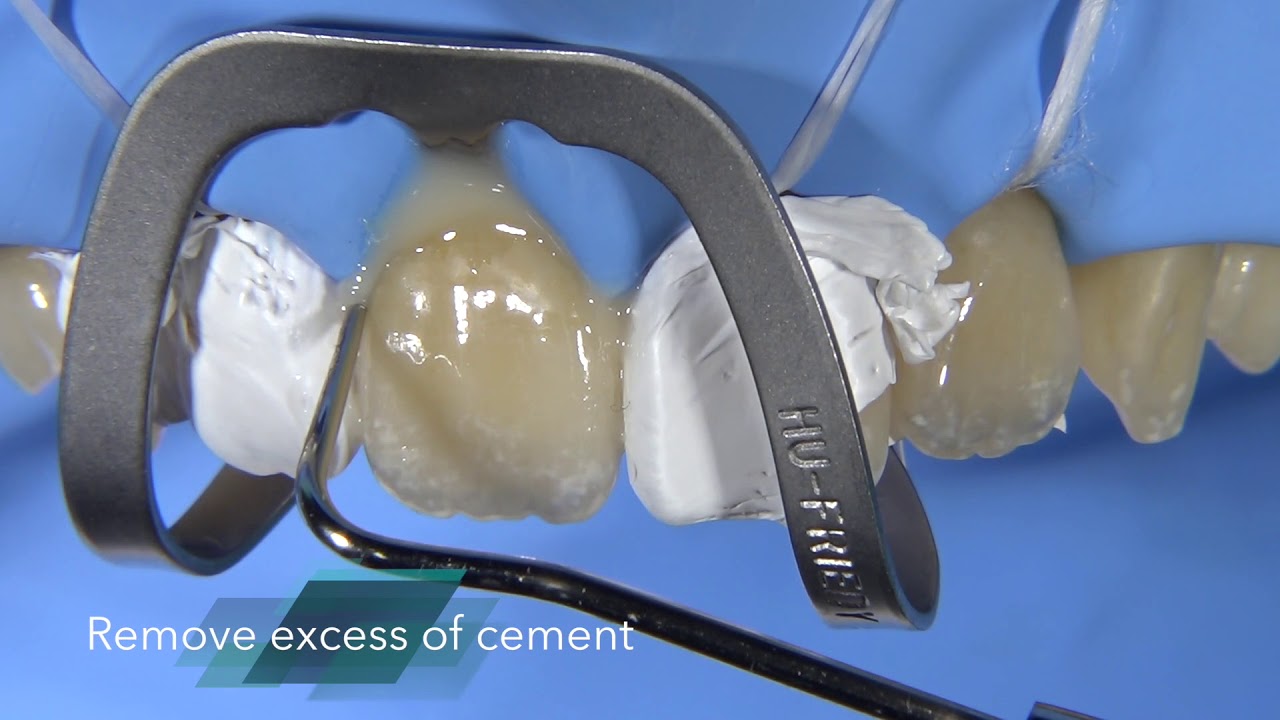 Veneer cementation with the resin cement G CEM LinkForce - YouTube
