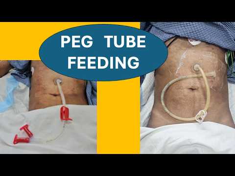 PEG Tube Dressing II PEG Feeding II Button PEG ( G-Button) - YouTube