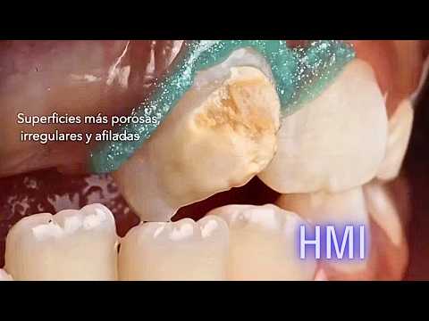 🦷 HMI: Hipomineralización Molar Incisivo