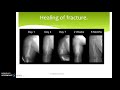 Wound healing and repair (part 2)- Fracture healing