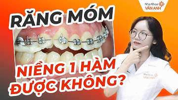 RĂNG MÓM CÓ NIỀNG 1 HÀM ĐƯỢC KHÔNG? GIẢI ĐÁP TỪ CHUYÊN GIA NHA KHOA VÂN ANH