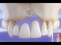 Implant dentaire vs Pont dentaire - Comparaison ©