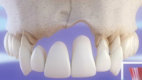 Quelle autre solution que l'implant dentaire