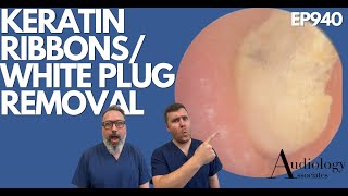 KERATIN RIBBONS/EAR WAX & WHITE PLUG REMOVAL FROM EAR - EP940