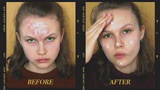 I&#39;ve started taking accutane to treat acne and I have something to say...