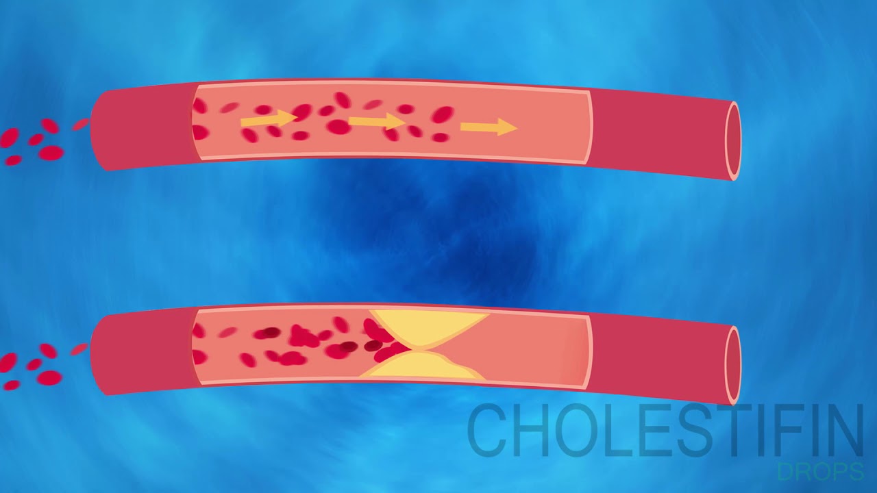 Cholestifin - The Natural Way To Reduce Bad Cholesterol Levels - YouTube