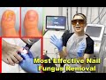 Toenail most effective fungus removal treatment with Laser (2023)