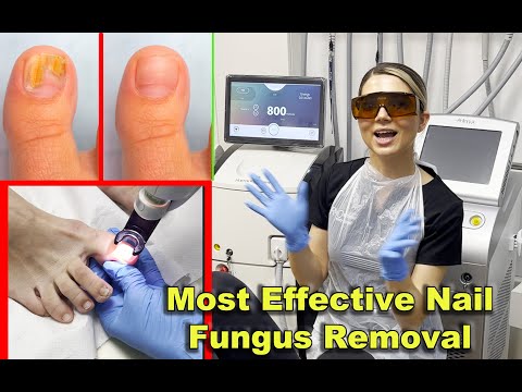 Toenail Most Effective Fungus Removal Treatment With Laser -2023-