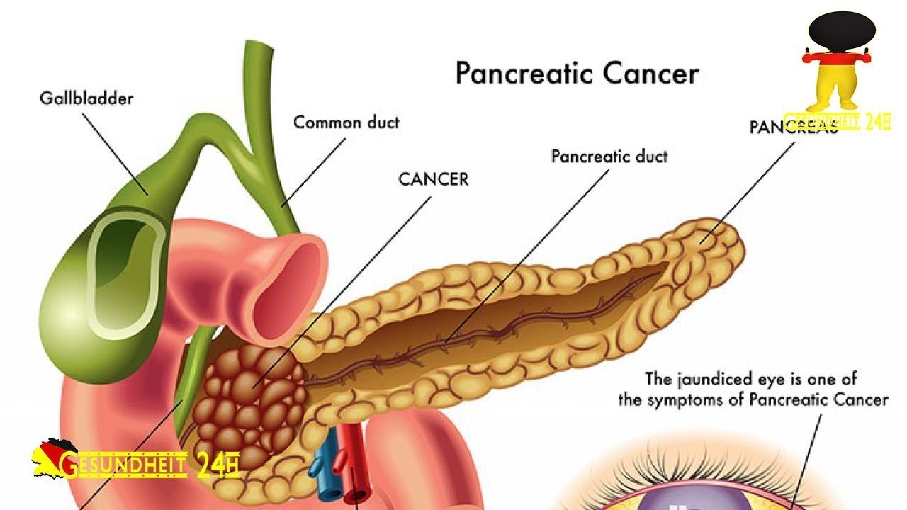 Como prevenir el cáncer de páncreas