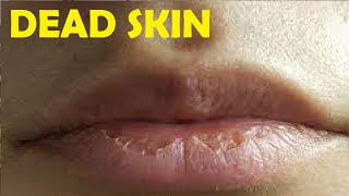 how to get rid of dead skin on your lips fast