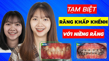 Sự thay đổi của răng khấp khểnh sau 6 tháng niềng răng