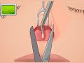 Operate now  nose surgery  educational body surgery games for kids