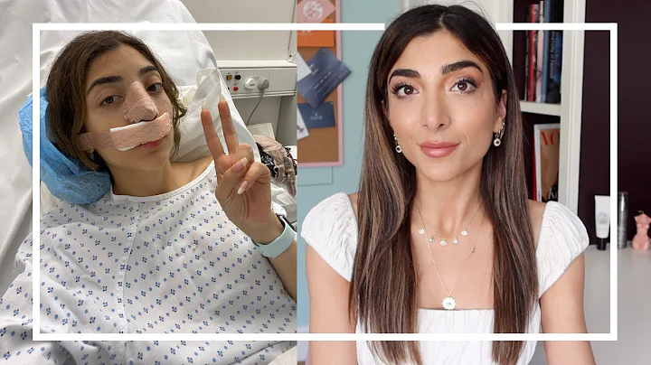 My Rhinoplasty Journey & Q+A | Amelia Liana