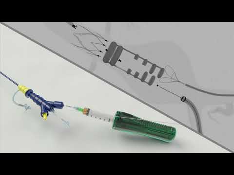 ALTO Deployment Animation MM 2200 Rev 02 - video from Endologix